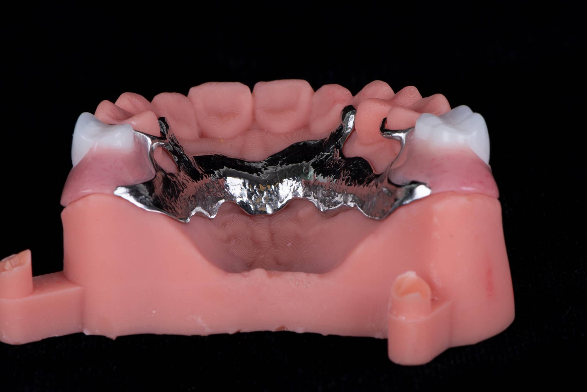 Removable partial denture on a 3D printed model